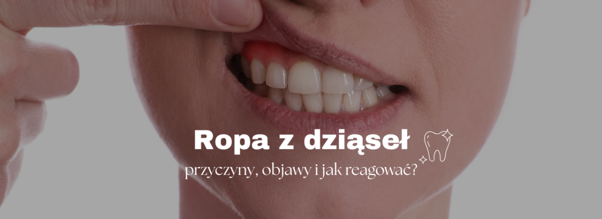Ropa z dziąseł – przyczyny, objawy i jak reagować?