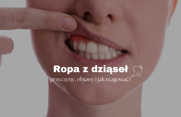 Ropa z dziąseł – przyczyny, objawy i jak reagować?