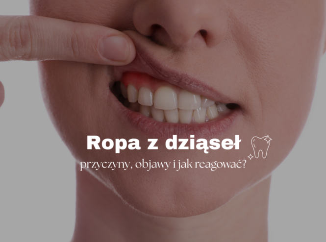 Ropa z dziąseł – przyczyny, objawy i jak reagować?