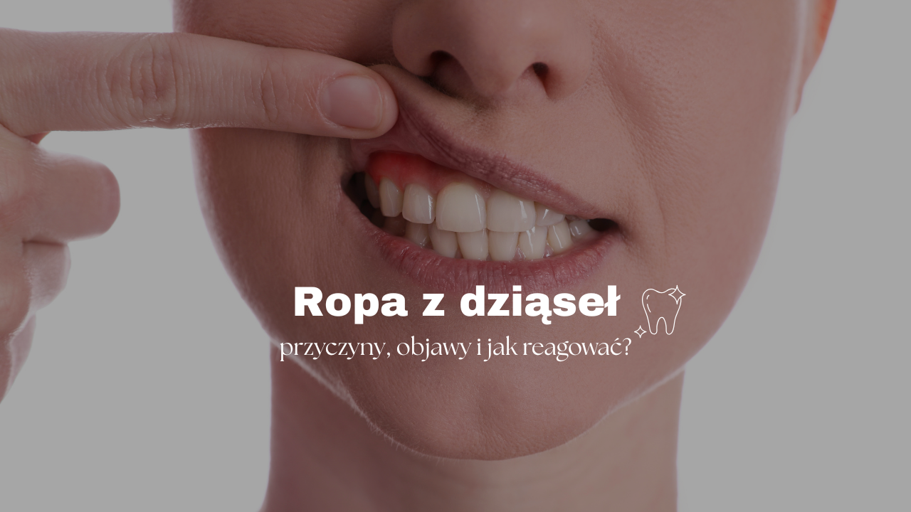 Ropa z dziąseł – przyczyny, objawy i jak reagować?