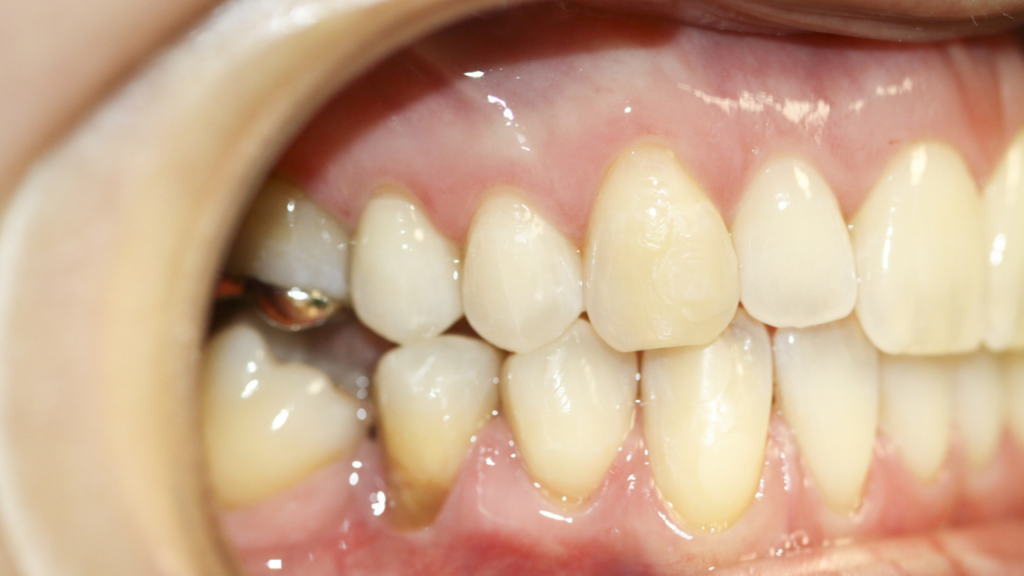 Zdrowe dziąsła są kluczowe dla trwałości implantów i prac protetycznych