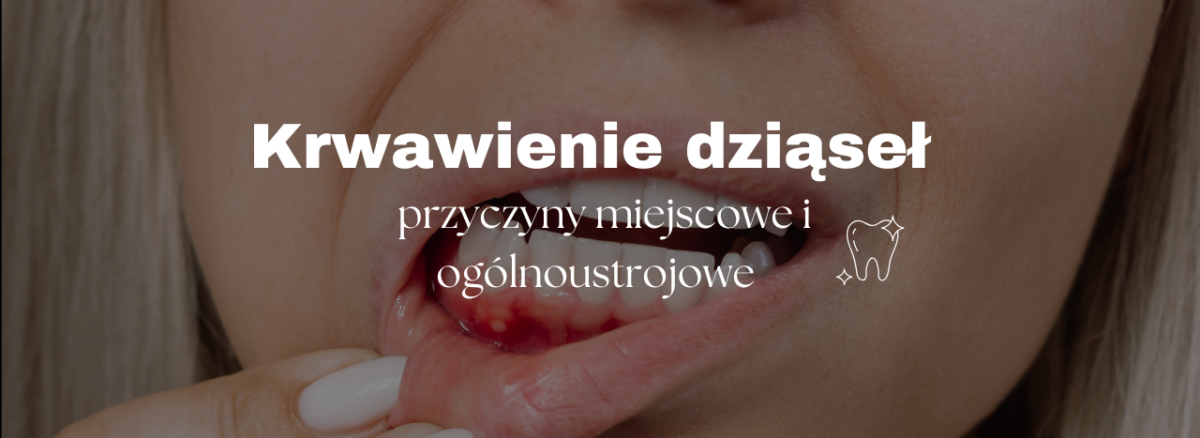 Krwawienie dziąseł - przyczyny miejscowe i ogólnoustrojowe