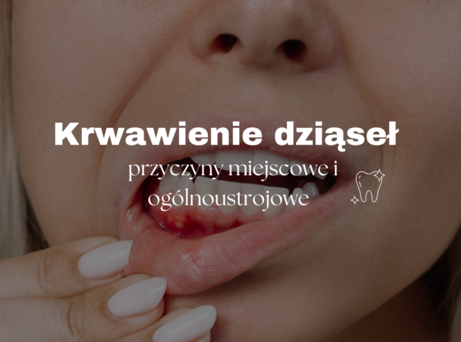 Krwawienie dziąseł - przyczyny miejscowe i ogólnoustrojowe