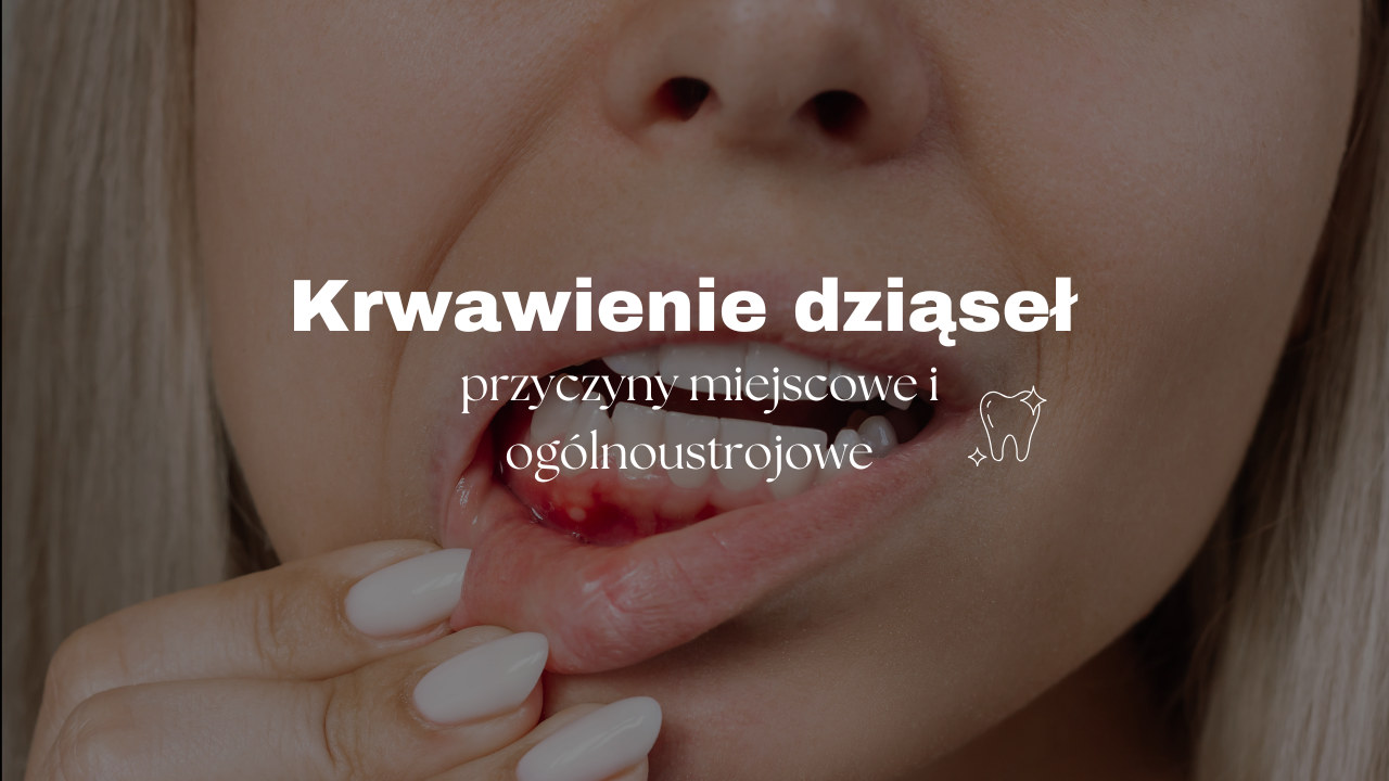 Krwawienie dziąseł - przyczyny miejscowe i ogólnoustrojowe
