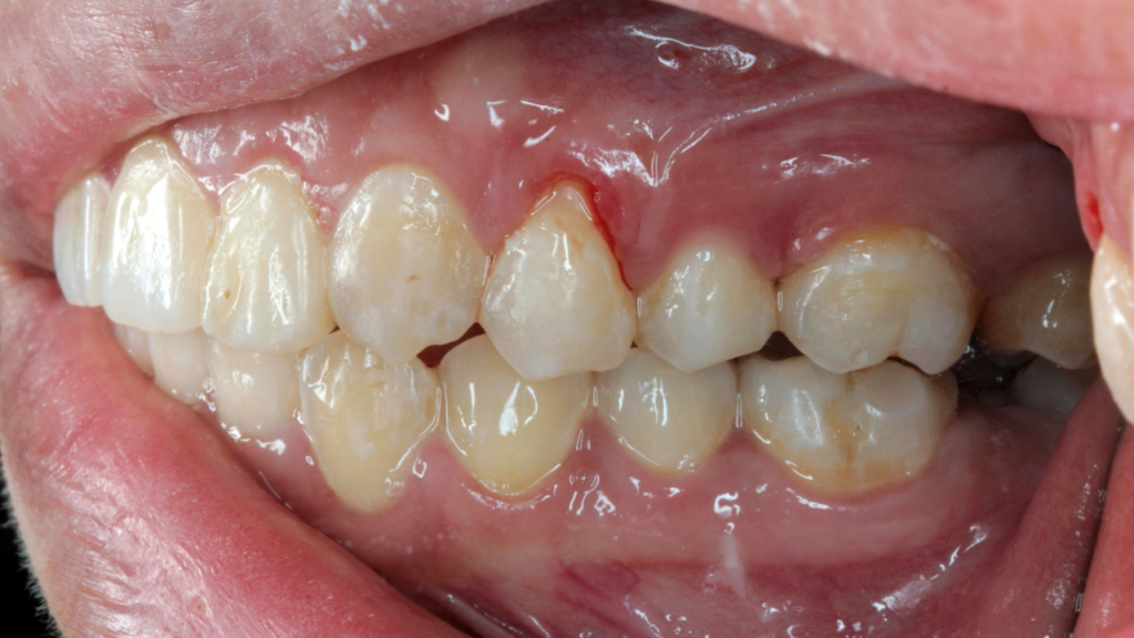 Krwawienie dziąseł to sygnał ostrzegawczy, którego nie warto bagatelizować