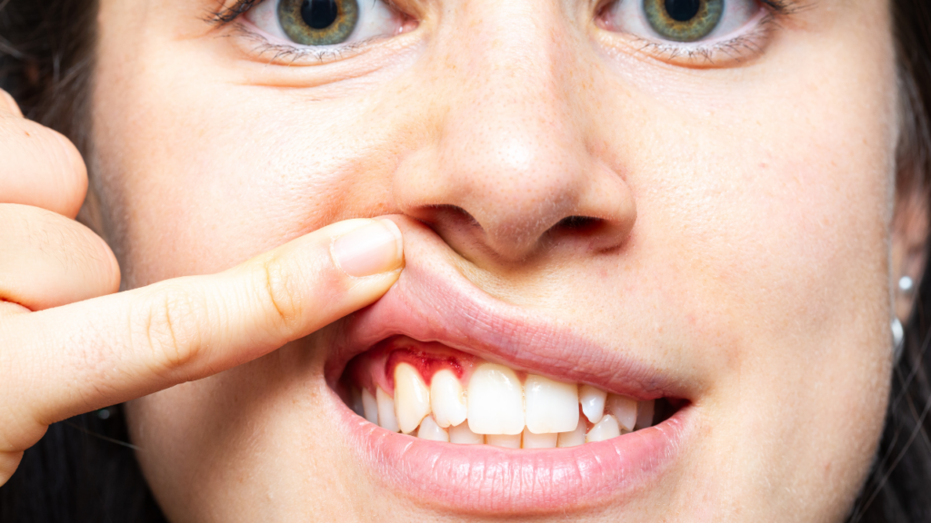 Nawet niewielkie krwawienie dziąseł może świadczyć o stanie zapalnym w jamie ustnej