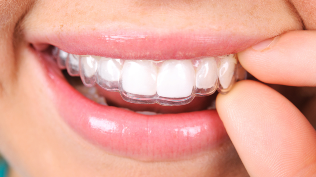 Regularne noszenie aparatu retencyjnego zmniejsza ryzyko cofania się zębów po leczeniu ortodontycznym