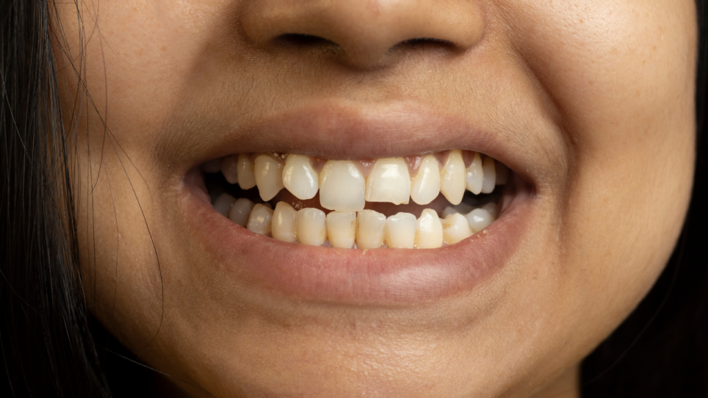 Ukruszony ząb -Czas leczenia zależy od skali uszkodzenia i zastosowanej metody