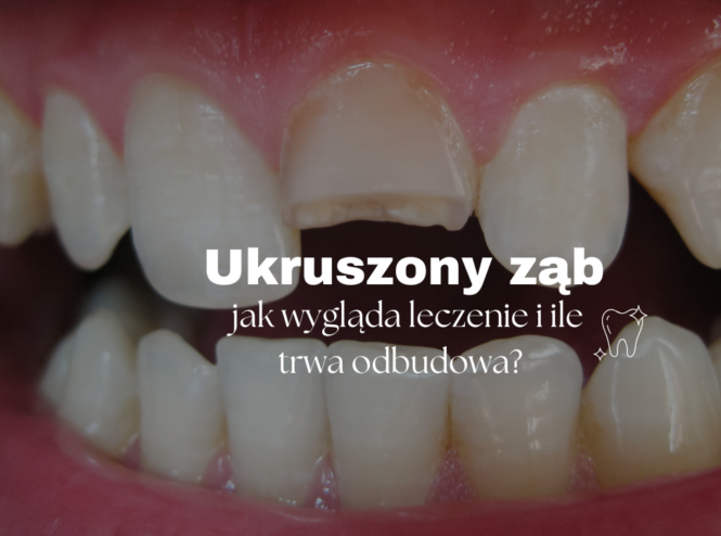 Ukruszony ząb - jak wygląda leczenie i ile trwa odbudowa?