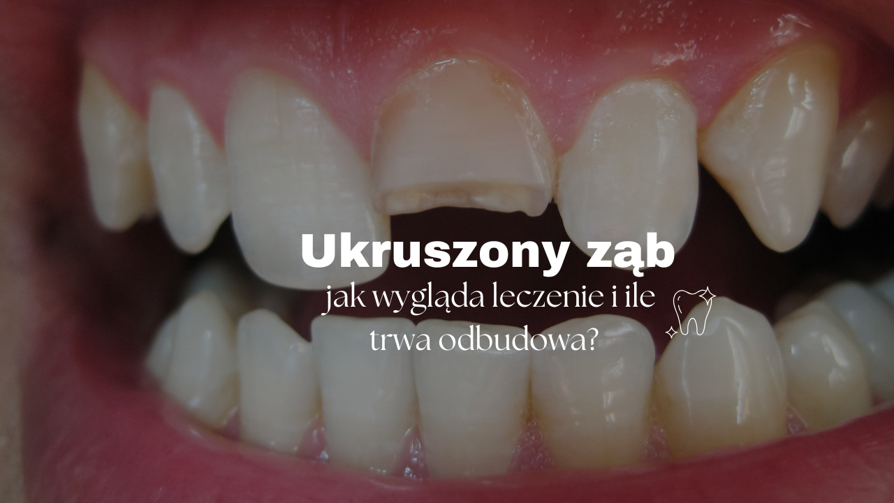 Ukruszony ząb - jak wygląda leczenie i ile trwa odbudowa?