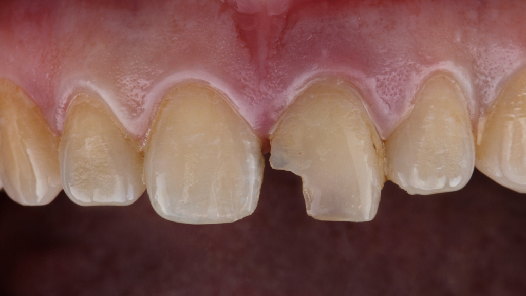 Ukruszony ząb to problem, którego nie warto ignorować - szybka reakcja zwiększa szanse na prostą odbudowę