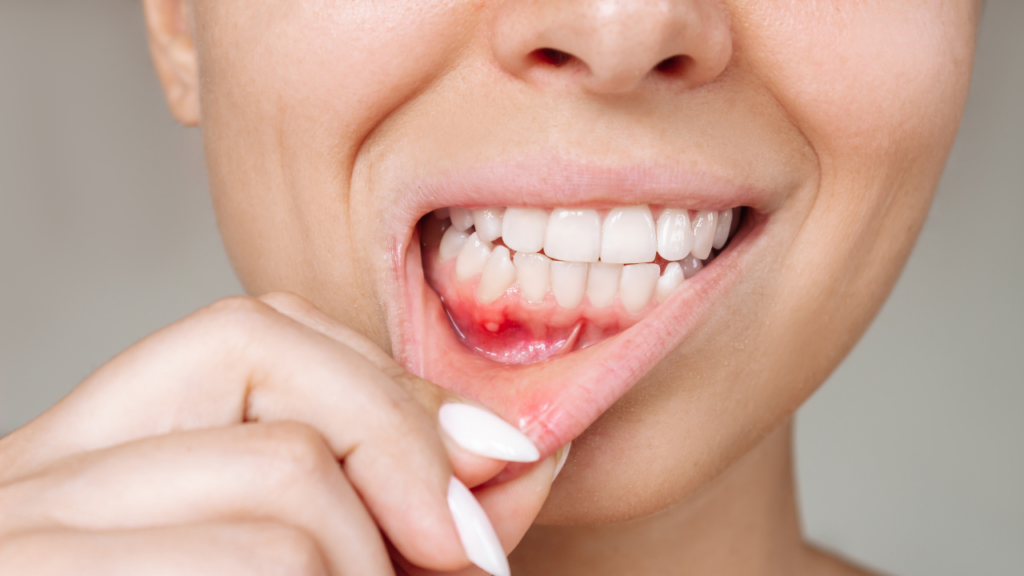 Narośl na dziąśle o charakterze zapalnym – częsta przyczyna wizyty u dentysty