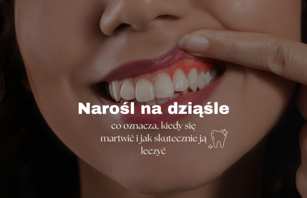 Narośl na dziąśle – co oznacza, kiedy się martwić i jak skutecznie ją leczyć