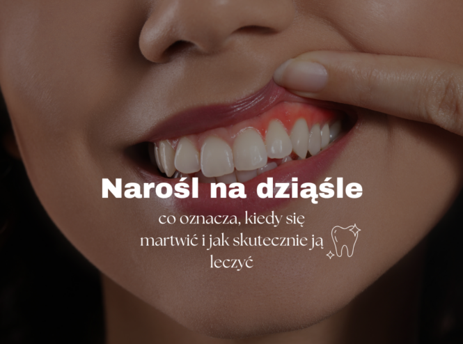 Narośl na dziąśle – co oznacza, kiedy się martwić i jak skutecznie ją leczyć