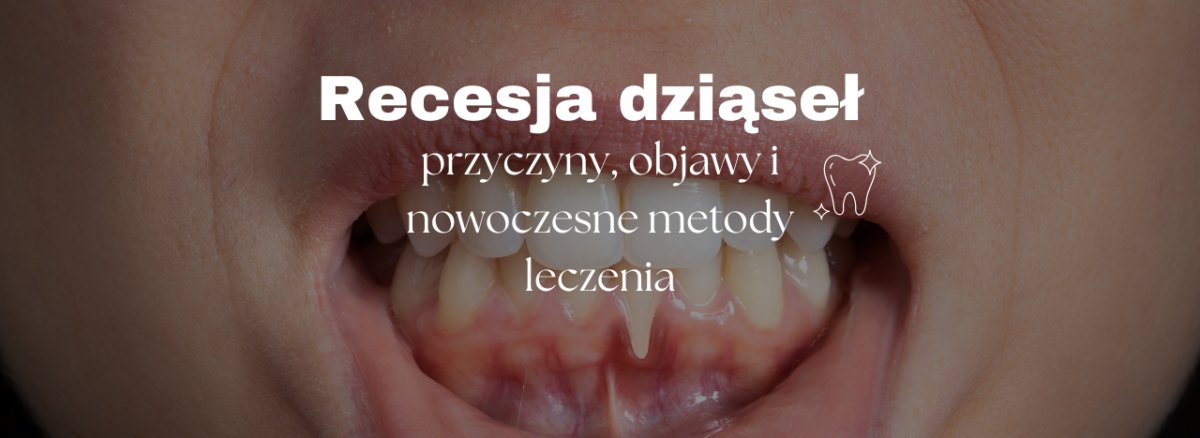 Recesja dziąseł - przyczyny, objawy i nowoczesne metody leczenia
