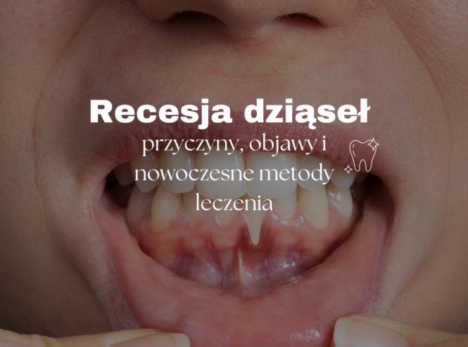 Recesja dziąseł - przyczyny, objawy i nowoczesne metody leczenia