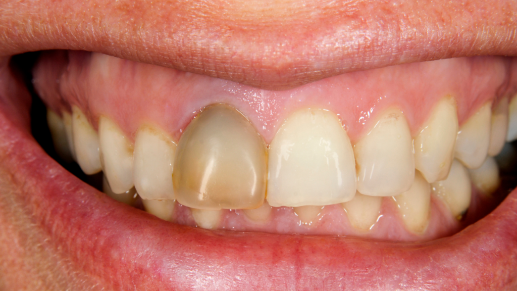 Przyczyny, przez które powstaje szary ząb – uraz, próchnica i leczenie kanałowe