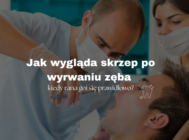 Jak wygląda skrzep po wyrwaniu zęba i kiedy rana goi się prawidłowo?