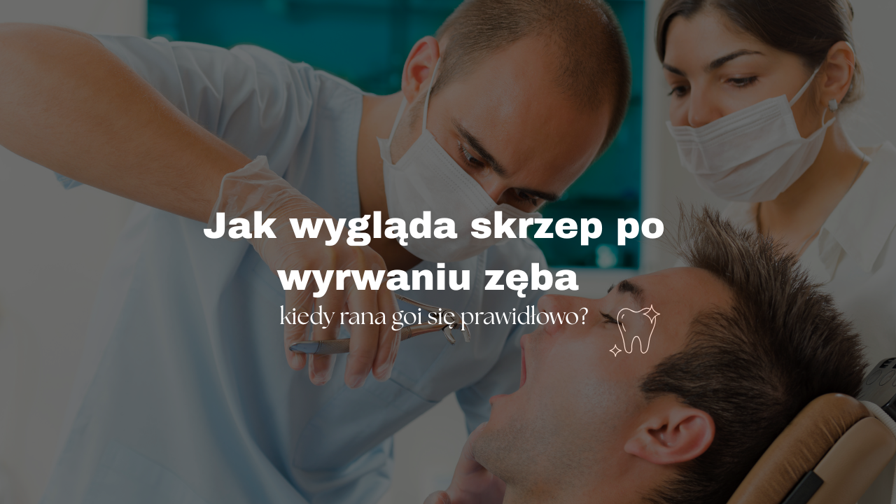 Jak wygląda skrzep po wyrwaniu zęba i kiedy rana goi się prawidłowo?