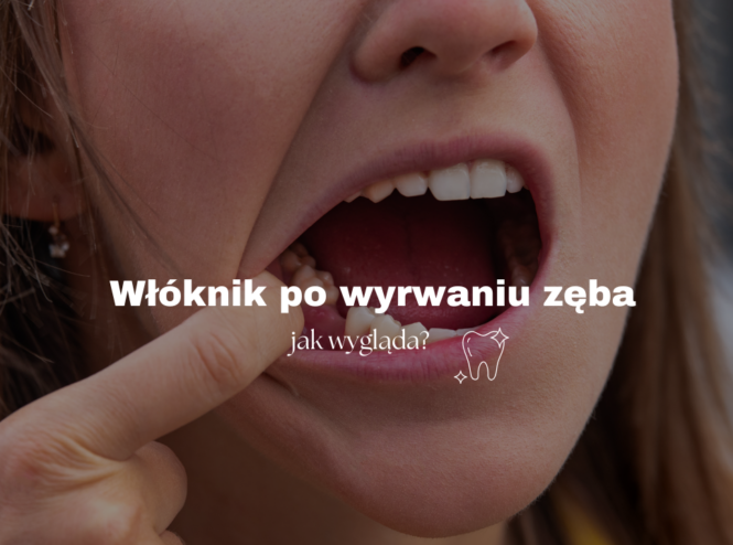Włóknik po wyrwaniu zęba - jak wygląda?