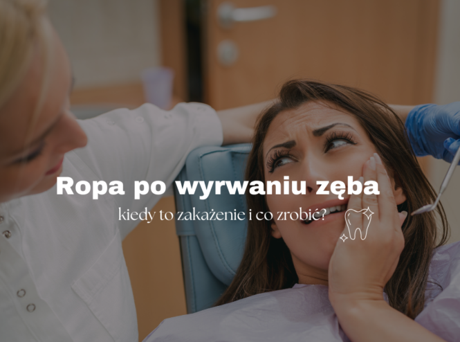 Ropa po wyrwaniu zęba - kiedy to zakażenie i co zrobić?