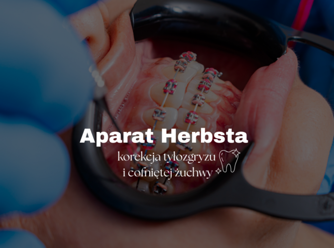 Aparat Herbsta - korekcja tyłozgryzu i cofniętej żuchwy