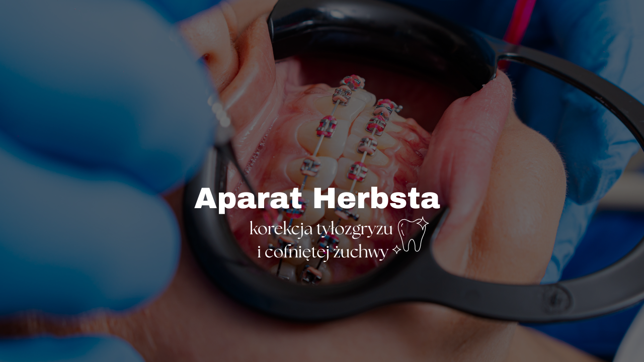 Aparat Herbsta - korekcja tyłozgryzu i cofniętej żuchwy