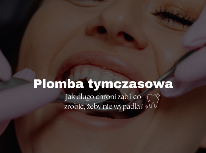 Plomba tymczasowa - jak długo chroni ząb i co zrobić, żeby nie wypadła?