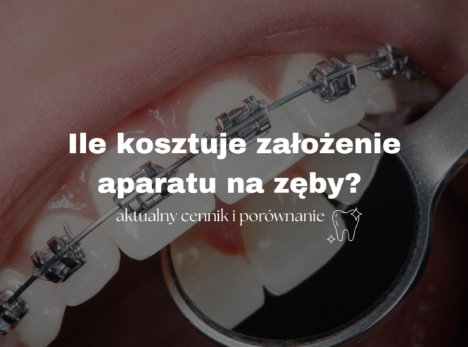 Ile kosztuje założenie aparatu na zęby? - Aktualny cennik i porównanie